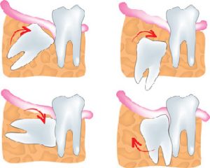Wisdow Teeth