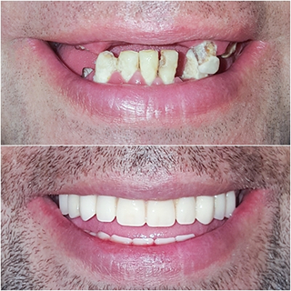 Teeth in a day - Implant Clinic