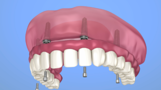 Implant Surgery