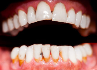 Periodontitis