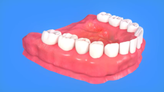 Ceramic bridges
