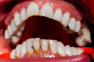 Gingivitis