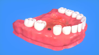 techniques used in dental implants