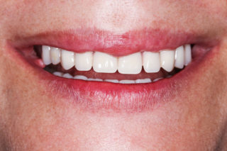 Dental Veneers