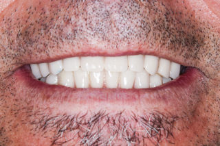 Teeth in a day