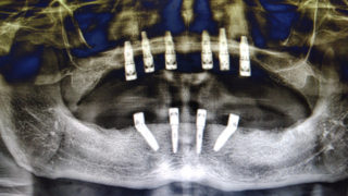 Full mouth dental Implants