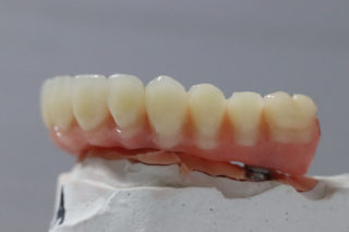 Implant Retained Dentures 