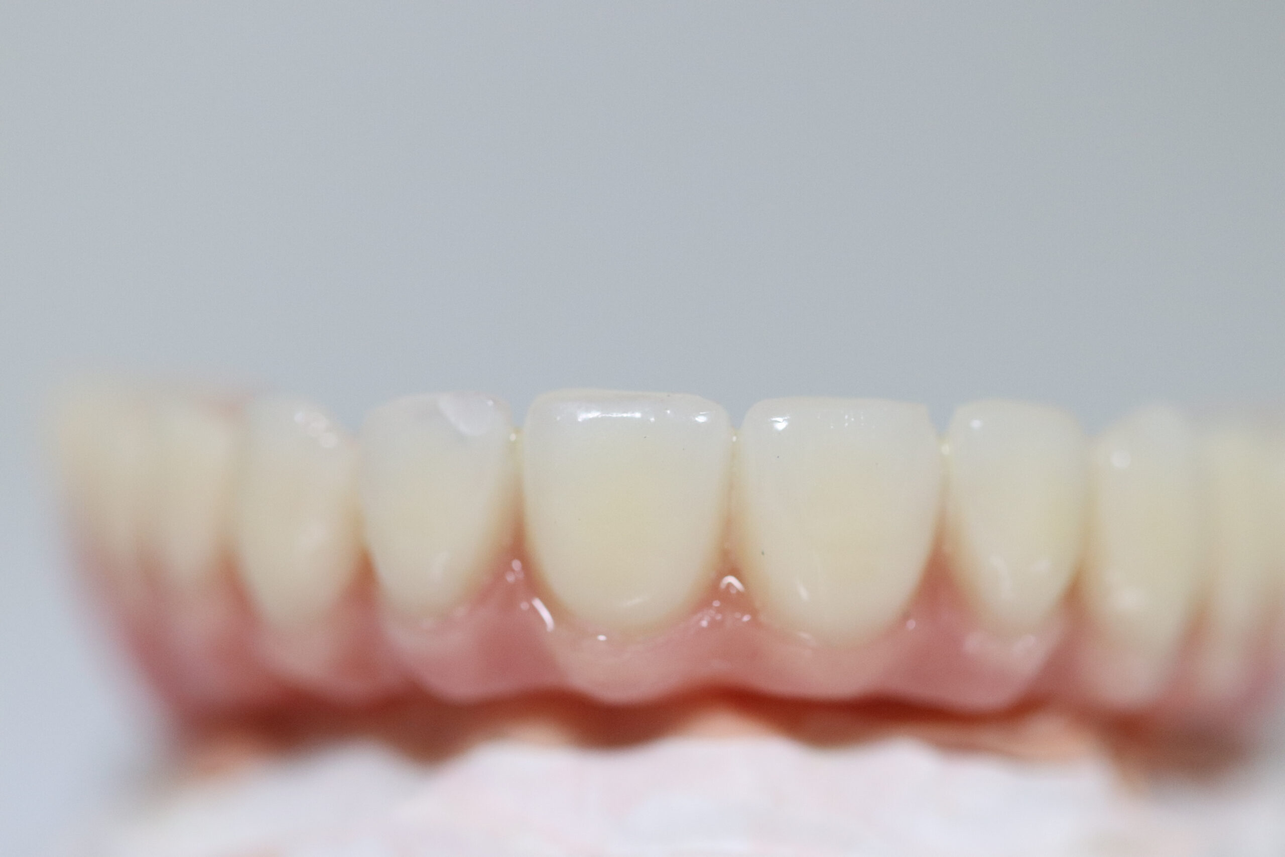 Dental Implant Bridge