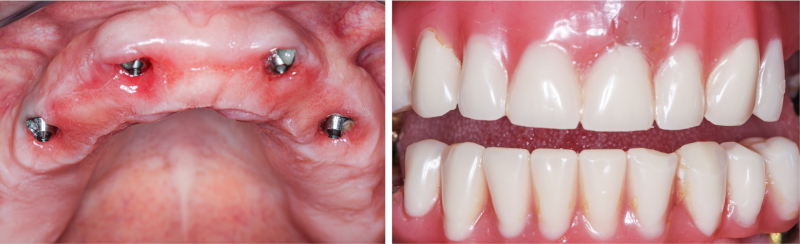 All on 4 dental Implants