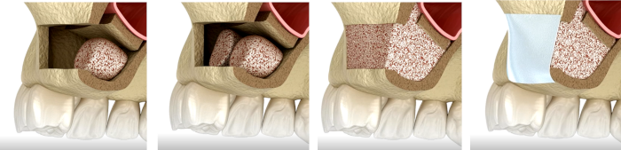 Bone Grafting