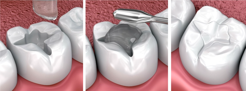 Dental Restoration - Clinic Abroad