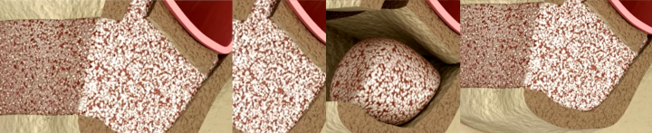 bone grafting materials
