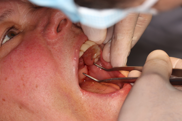 Tooth Extraction in Fall River