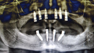 Full-mouth-dental-Implants