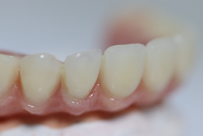 Implants to Fix Dentures