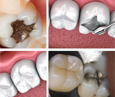 Amalgam Fillings