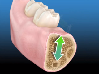 Bone Grafting