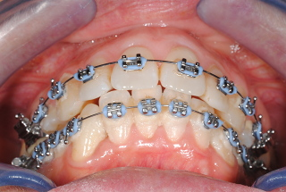 Orthodontic treatment