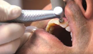 Dental restouration