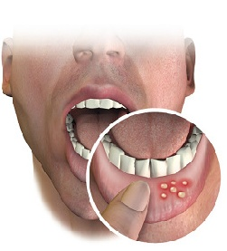 mouth ulcers