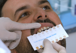 Tooth whitening