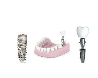 single tooth implant